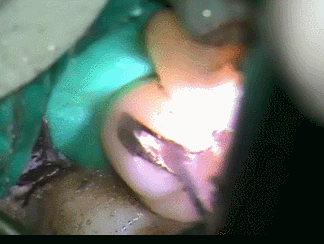 左下6金属除去 2014.06.27　2.gif